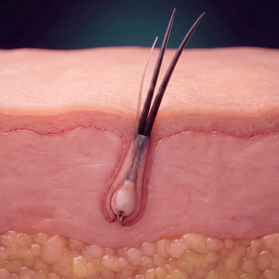 Medical illustration: between months six and twelve the unit grows two or three hairs of different thickness