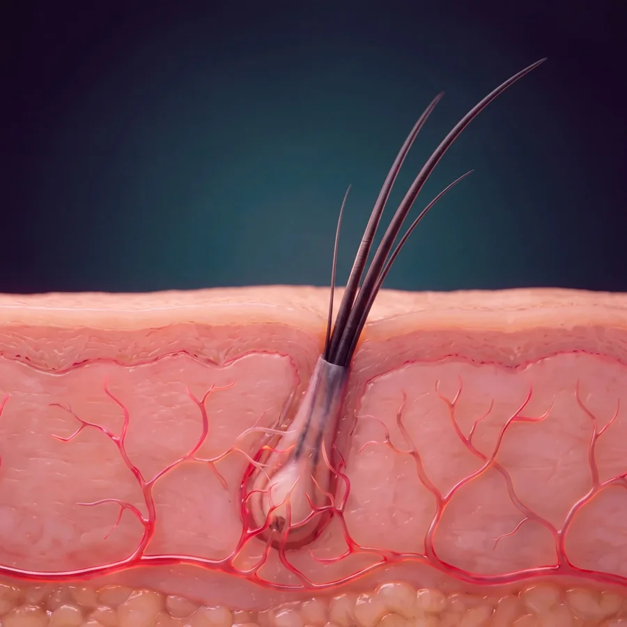 Medical illustration: at month twelve the transplanted follicle is fully integrated with full-length hairs