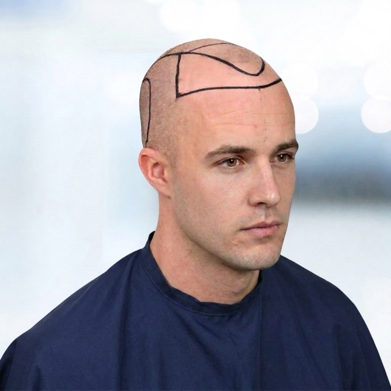 Hairline and Crown, before, the design drawn on the patient