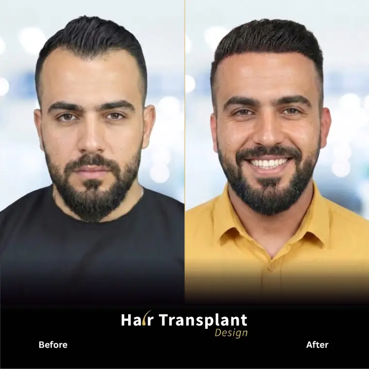 Temples and hairline restoration, before and after