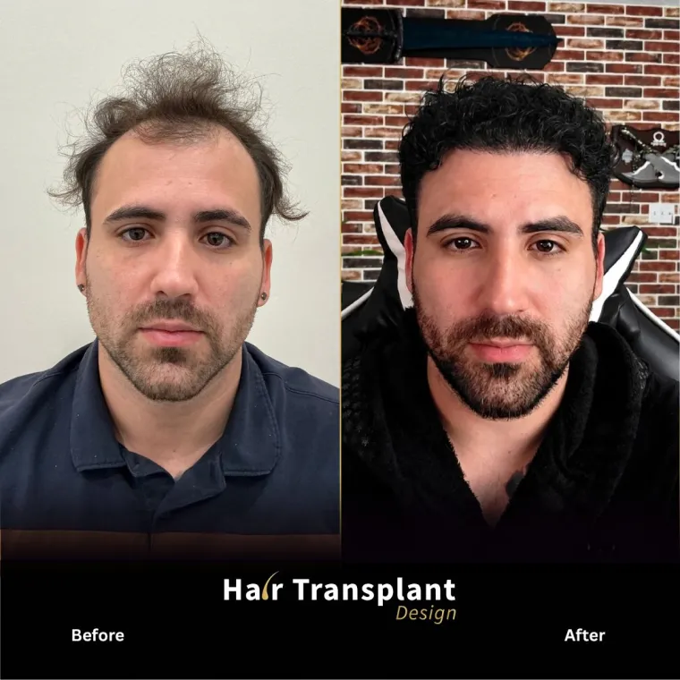 Before and after hair transplant in Tampa: front and mid-scalp restored with 4,000 grafts