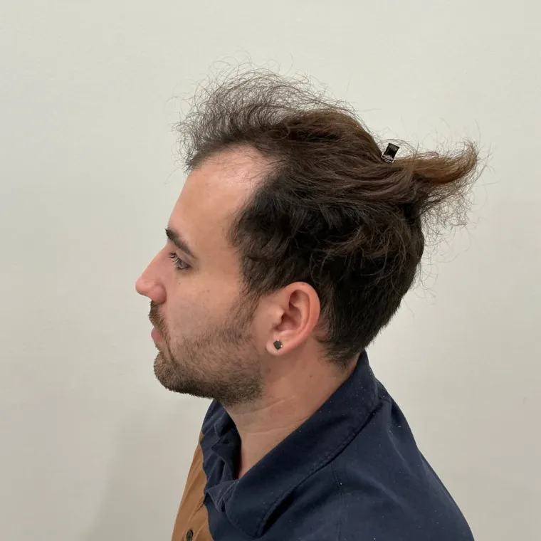 Front and mid-scalp restoration, before, profile, Hair Transplant Design Tampa