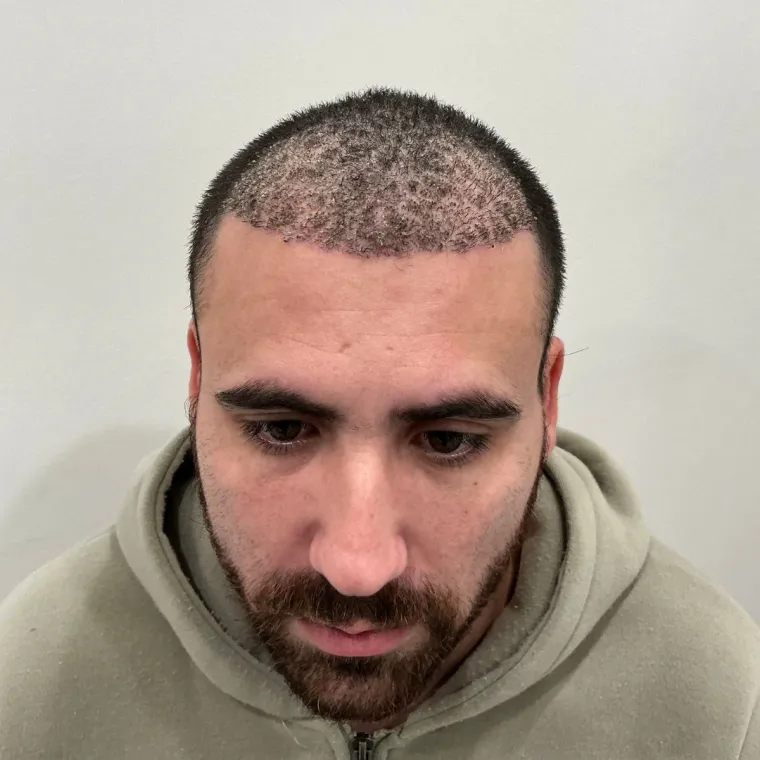 Front and mid-scalp restoration, the first days, healing, Hair Transplant Design Tampa