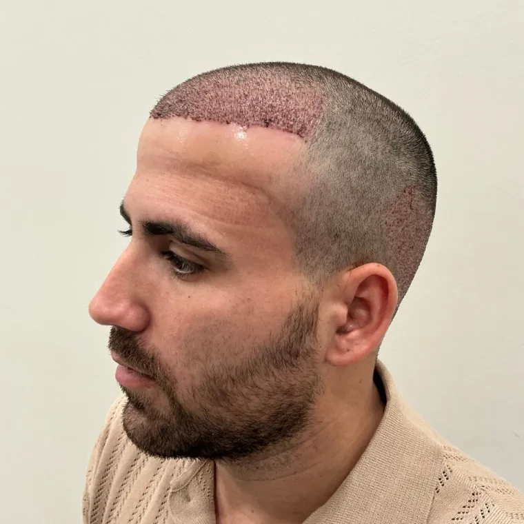 Front and mid-scalp restoration, the day of surgery, profile, Hair Transplant Design Tampa