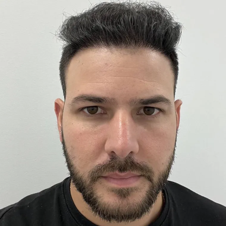 Super full hair restoration, after, front view, Hair Transplant Design Tampa