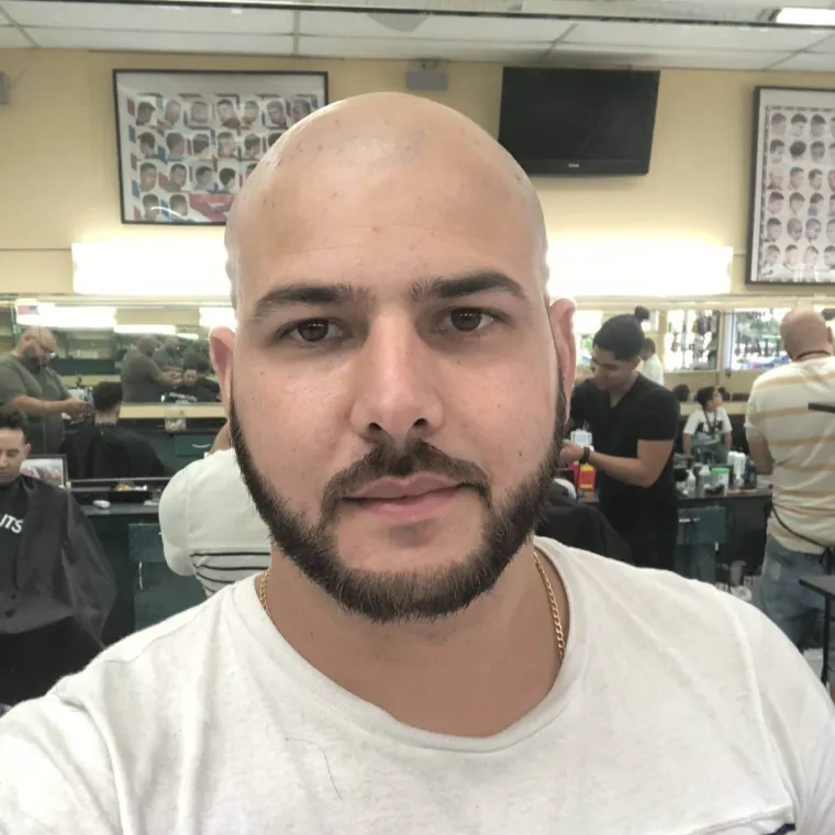 Super full hair restoration, before, Hair Transplant Design Tampa