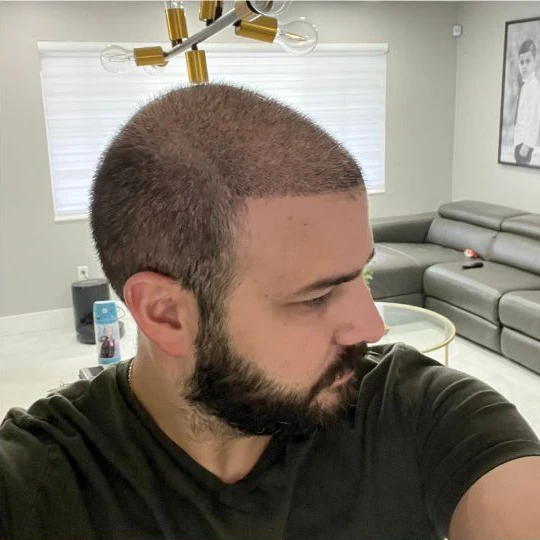 Super full hair restoration, growing in, profile, Hair Transplant Design Tampa