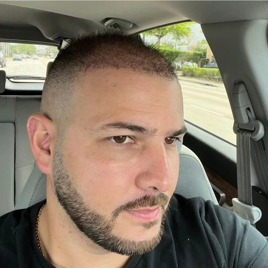 Super full hair restoration, growing in, filling out, Hair Transplant Design Tampa