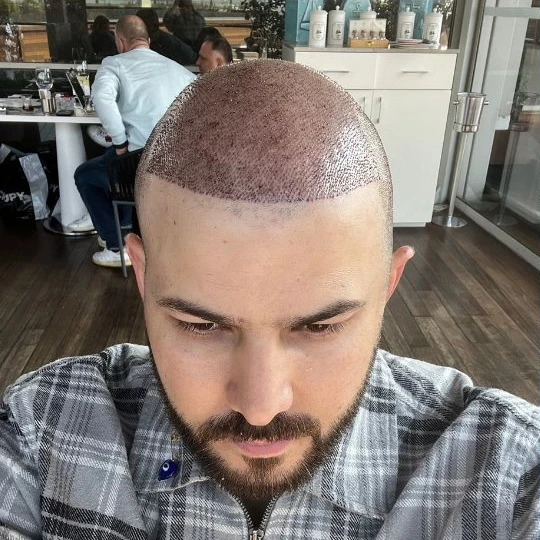 Super full hair restoration, the first days, from above, Hair Transplant Design Tampa