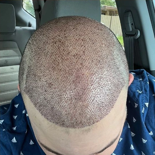 Super full hair restoration, the first days, settling in, Hair Transplant Design Tampa
