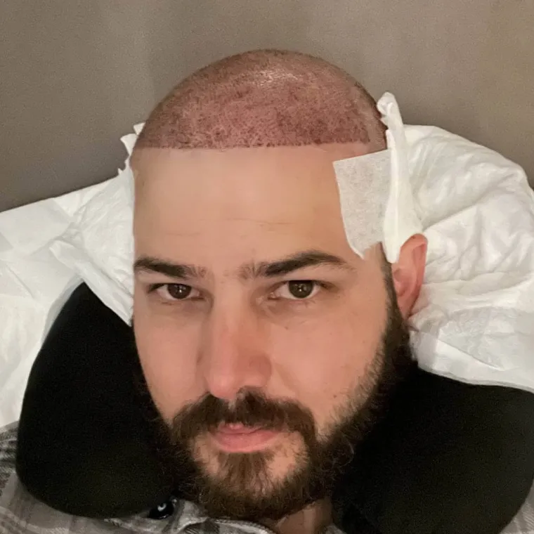 Super full hair restoration, the day of surgery, Hair Transplant Design Tampa