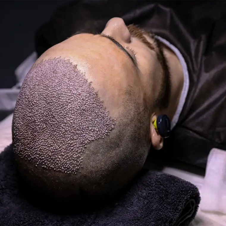 Freshly implanted FUE grafts covering the designed zone