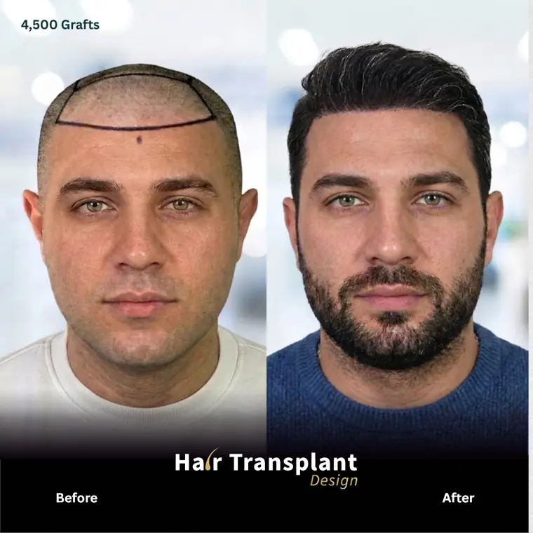Antes y después de un trasplante capilar FUE en Tampa: restauración frontal completa con 4,500 injertos