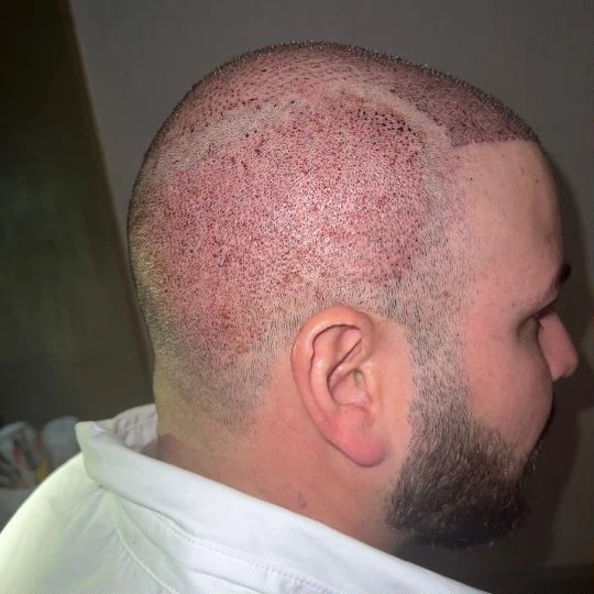 Restauración capilar súper completa, los primeros días, cicatrización, Hair Transplant Design Tampa