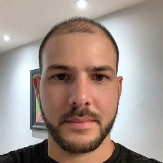 Restauración capilar súper completa, en crecimiento, de frente, Hair Transplant Design Tampa