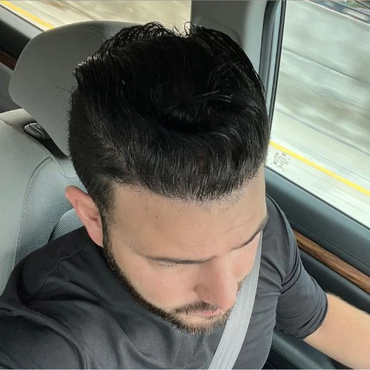 Restauración capilar súper completa, después, peinado, Hair Transplant Design Tampa
