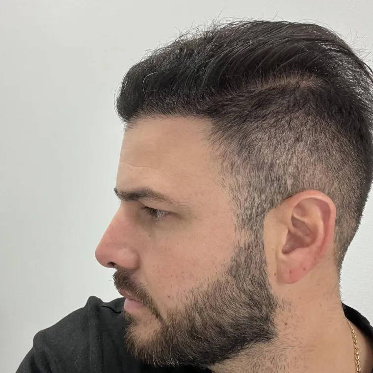 Restauración capilar súper completa, después, perfil, Hair Transplant Design Tampa
