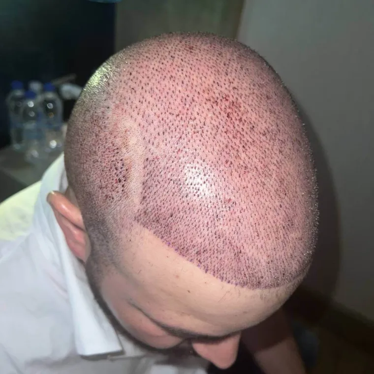 Restauración capilar súper completa, el día de la cirugía, zona receptora, Hair Transplant Design Tampa