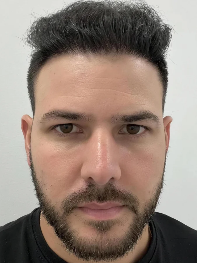 Ra&uacute;l after 5,500 grafts at Hair Transplant Design: full hairline and density