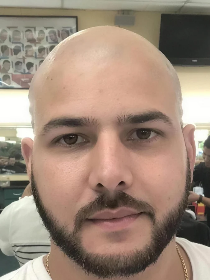 Ra&uacute;l before his hair transplant, head shaved with advanced hair loss